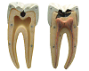 Dental Caries Model
