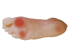 Advanced Diabetic Foot Nursing Model